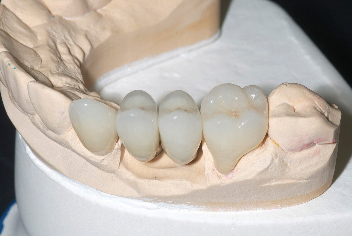 Врач который коронки на зубы называется. Коронка цельнолитая, зуб цельнолитой. Чистые зубы. Ортопедия зубов. Врач который коронки на зубы называется.