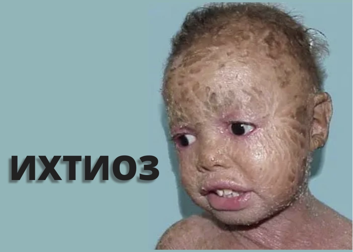 Ихтиоз - симптомы и диагностика, цены на лечение ихтиоза в Москве в клинике Хадасса