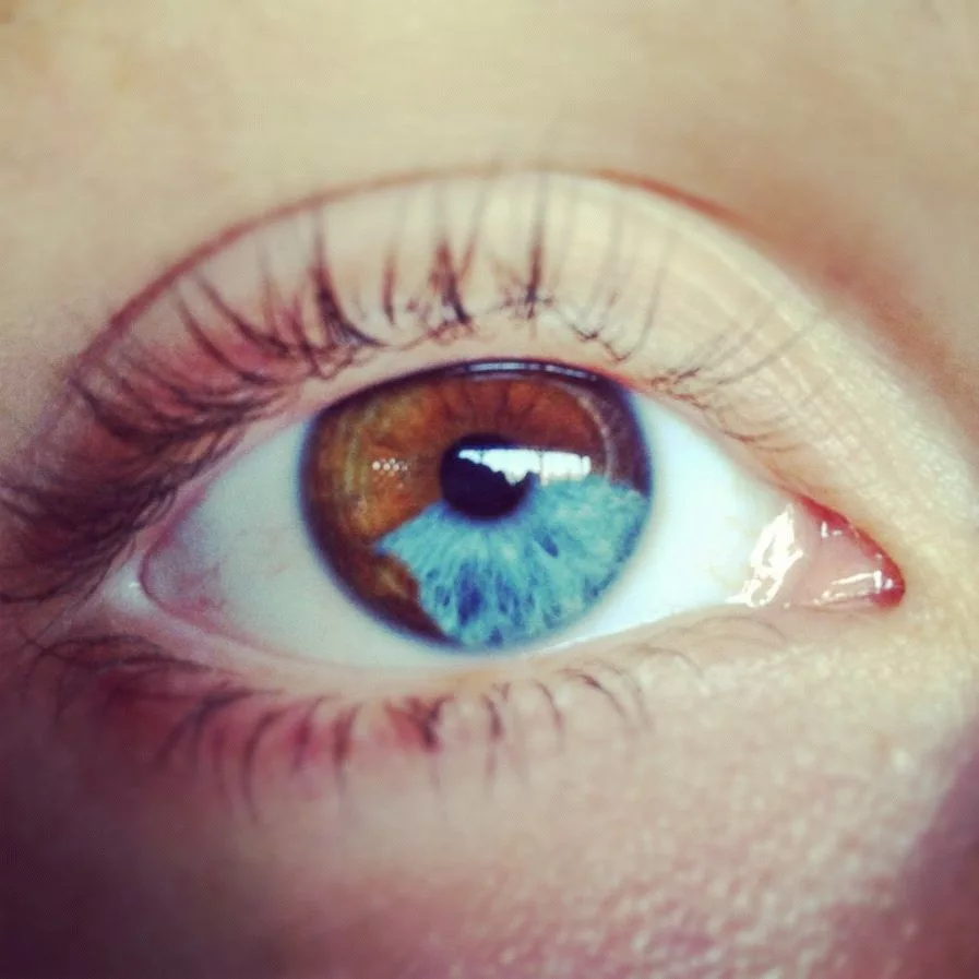 Как называется болезнь когда разный цвет глаз. Гетерохромия радужной оболочки. Центральная гетерохромия карих глаз. Секторная гетерохромия карих глаз. Гетерохромия Радужки глаз.