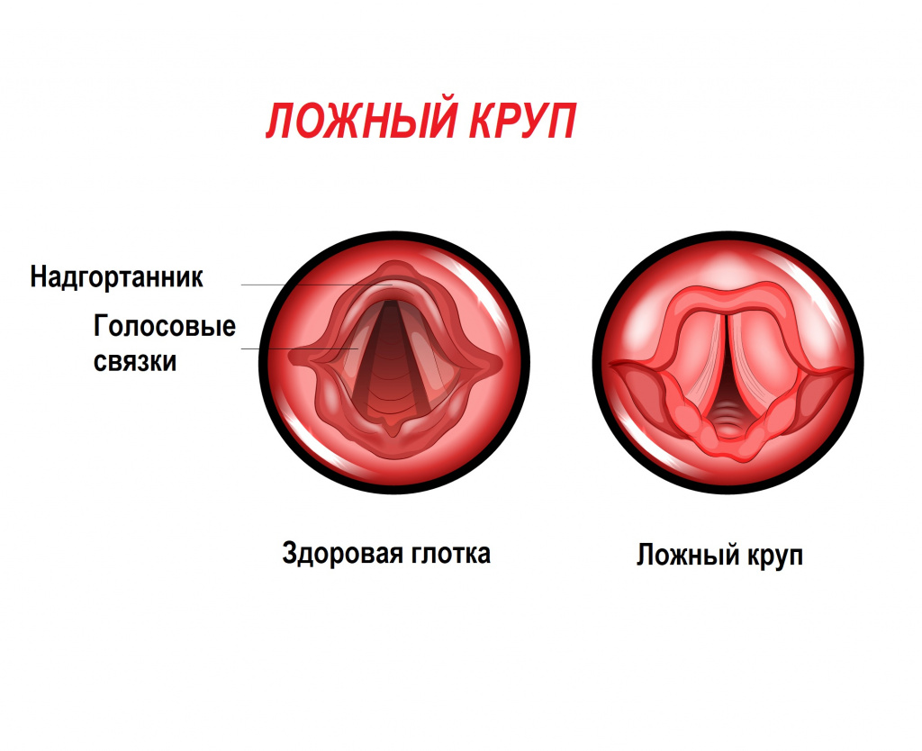 Презентация круп у детей