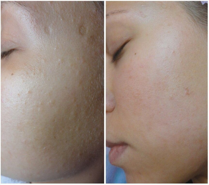 Как выглядит лицо после чистки Gateway Aesthetic Institute and Laser Center, university, college, United States