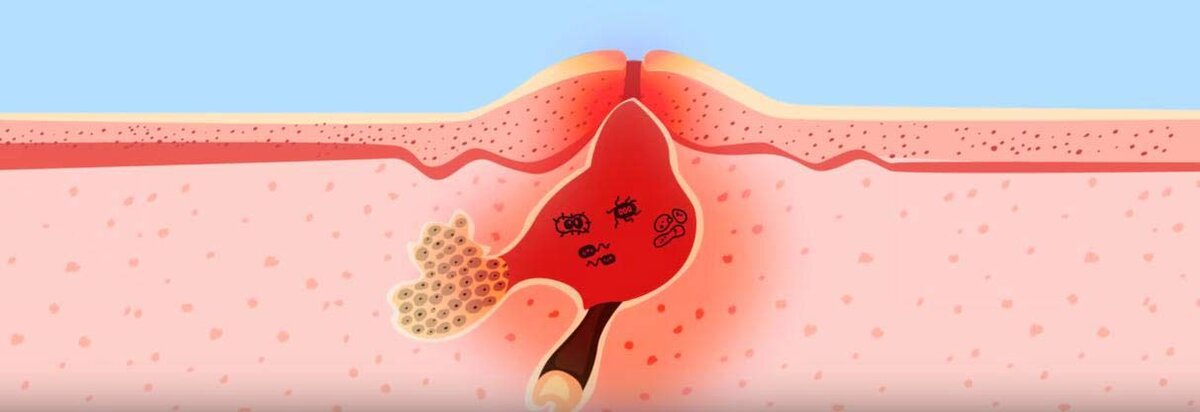 Почему появляется прыщ? 