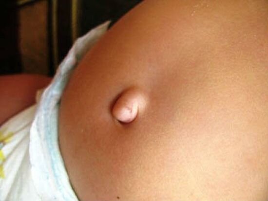 
Если ширина пупочного кольца не больше 15 мм, то выпячивание исчезает само к 5–7-летнему возрасту