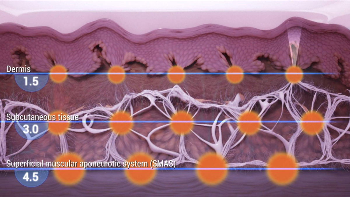 лифтинг на уровне мышечно-апоневротической системы SMAS