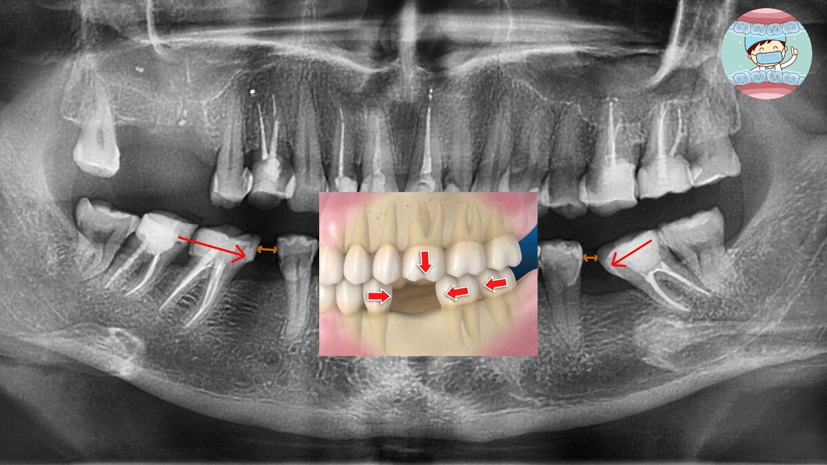 Красными стрелочками показано, в каком направлении смещаются зубы, а коричневыми - насколько мало места осталось между зубами. К сожалению, коронка туда не поместится.