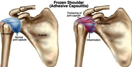 нормальный плечевой сустав и замороженный сустав