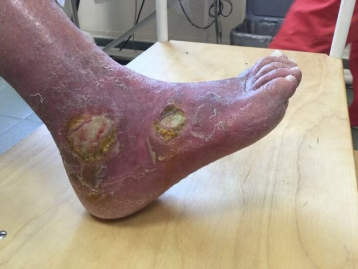 дезоморфин 