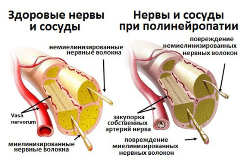 Нейропатия что это. Кавернозный синдром полинейропатии. Диабетической периферической нейропатии. Диабетическая периферическая полинейропатия. Нейропатия периферических нервов.