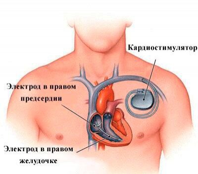 Аритмия сердца: лечение народными средствами - блог центра «ВинАльфа-Мед»