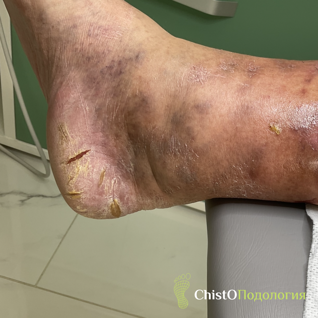 Глубокие эпидермо-дермальные трещины 