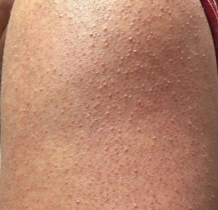 Гусиная кожа — фолликулярный кератоз