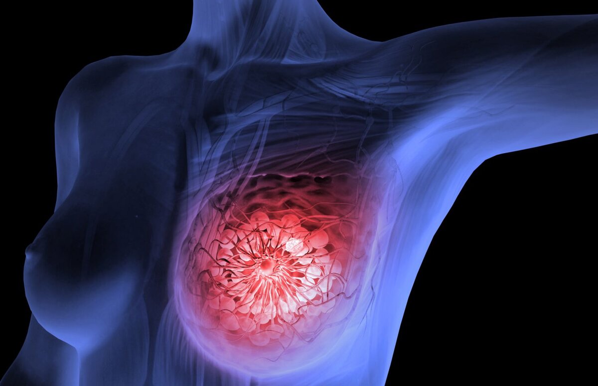 Опасность маммографии: как уберечь себя от рака груди!