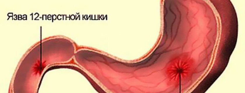 Язва двенадцатиперстной кишки