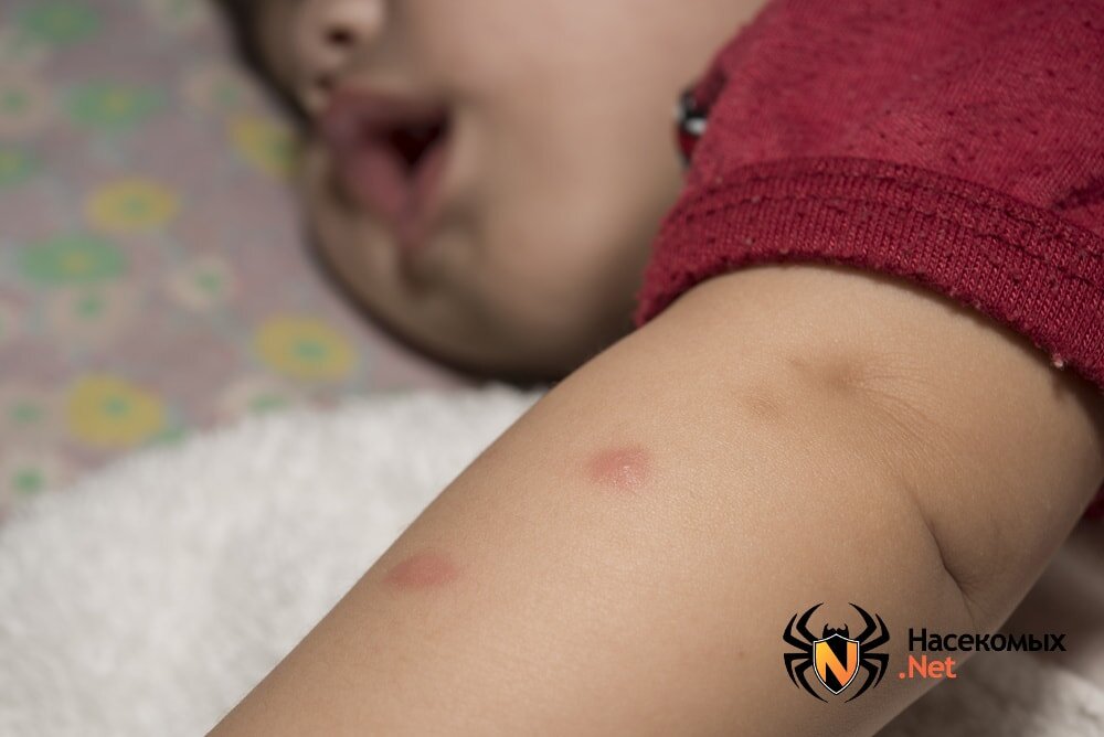 Аллергия на укусы комаров у детей: опасно ли это?