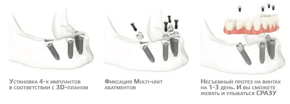 Схема установки имплантов зубов на нижней челюсти