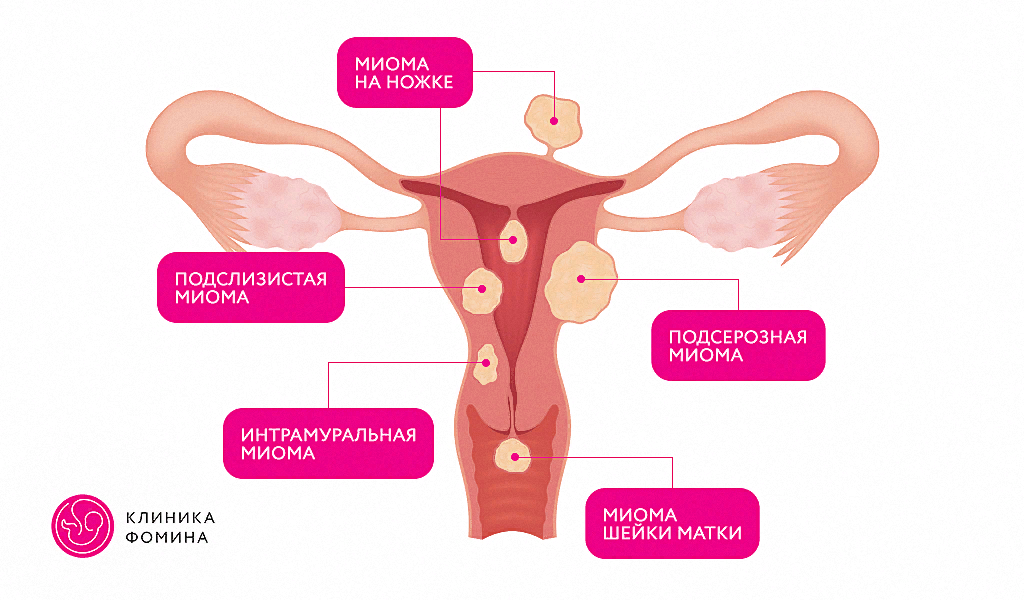 Опухоль может возникать на разных участках матки — внутри мышечного слоя или на его границе с внутренней или внешней стенкой.