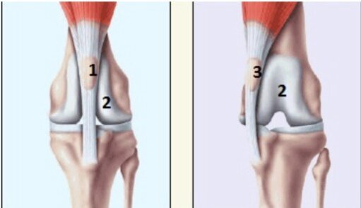 1-нормально расположенная коленная чашка, 2-желоб бедренной кости, 3-смещенная при вывихе коленная чашка

