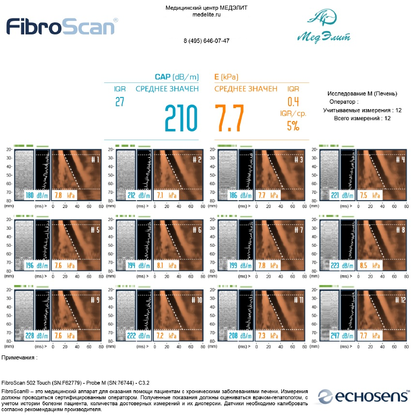 Пример корректного заключения. Голубое число (САР) - стеатоз (ожирение печени). Оранжевое число (Е) - фиброз (эластичность печени). Значение IQR/ср. должно быть меньше 30 % (чем меньше - тем качественнее проведено исследование и точнее результат). Количество успешных измерений должно быть не менее 60% (сверху справа учитываемые измерения и всего измерений, в идеале они должны совпадать, чем меньше разница - тем лучше). В зависимости от причины заболевания печени полученные показатели соответствуют той или иной стадии стеатоза и фиброза.