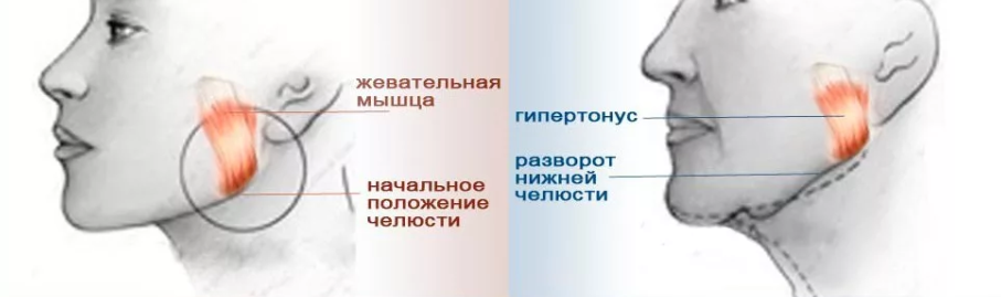Как выглядит гипертонус мышц лица