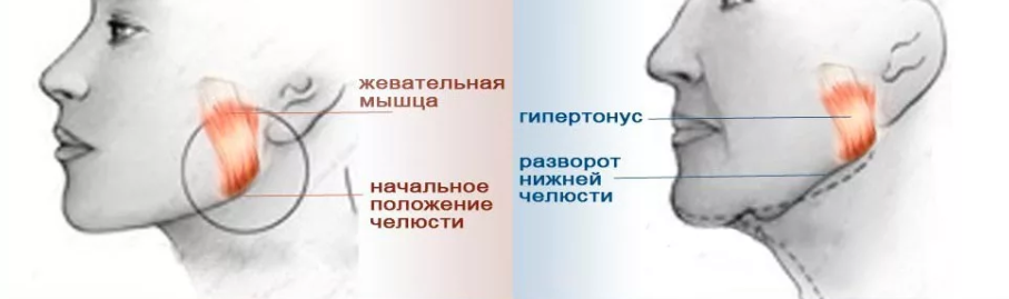 Гипертонус как расслабить. Гипертонус жевательных мышц. Гипер тонус жеватльных мышц. Гипертонус и гипотонус мышц лица.