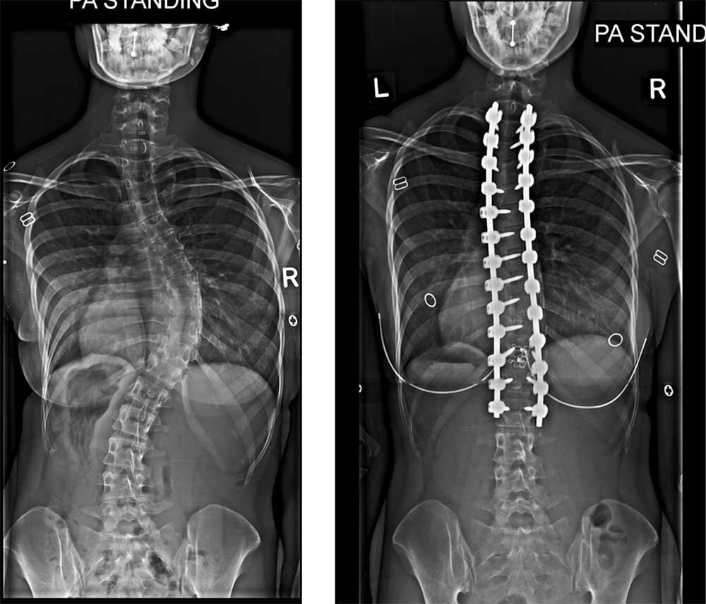 Сколиоз грудного отдела позвоночника. Левосторонний сколиоз рентген. Левосторонний сколиоз поясничного отдела рентген. С-образный сколиоз рентген. Идиопатический сколиоз рентген.