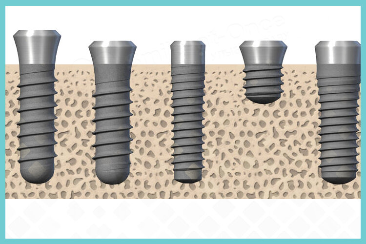 Оба термина касаются стабильности импланта в толще кости