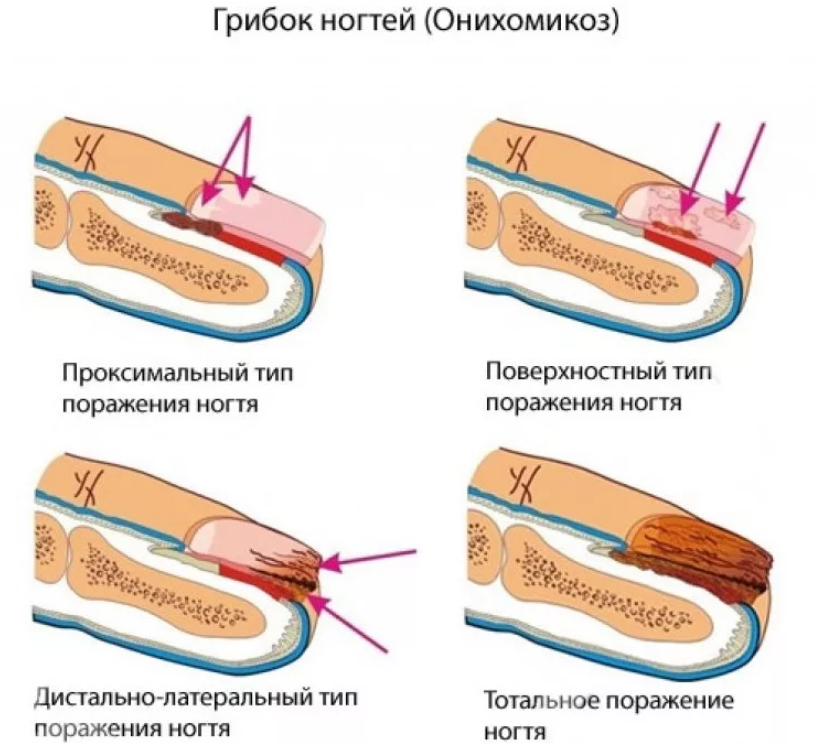 Различные формы грибкового заболевания