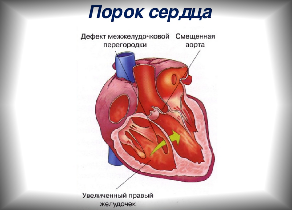 Прогноз пороке сердца