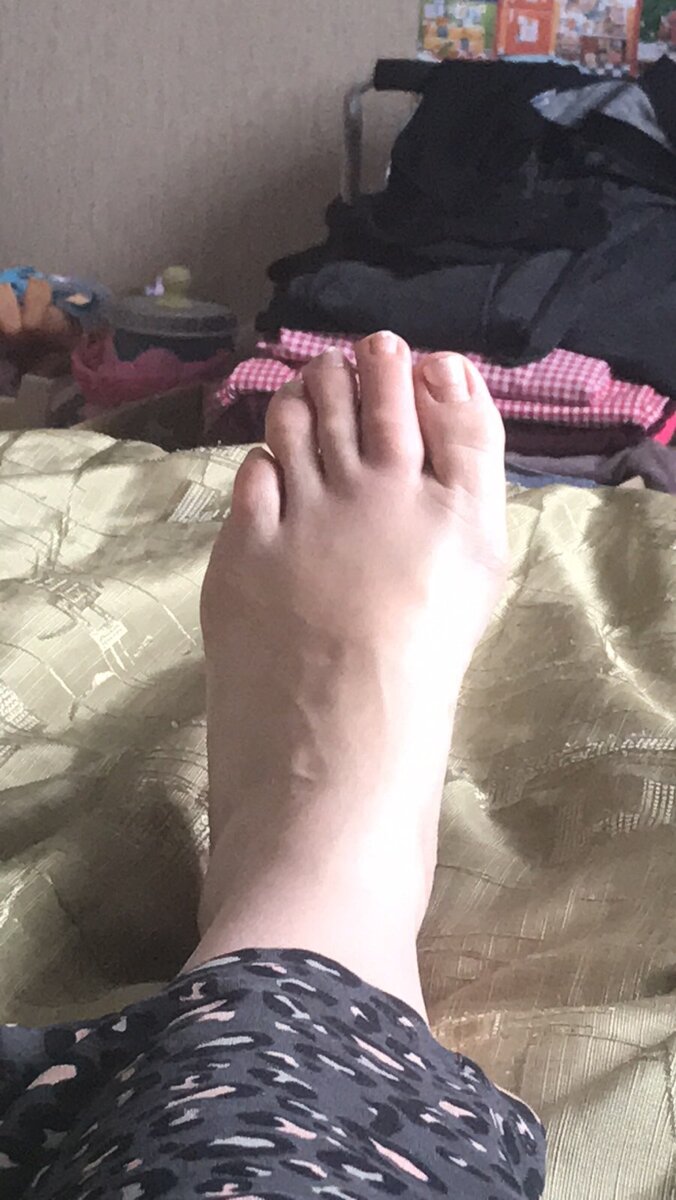 Так выглядели пальцы в январе