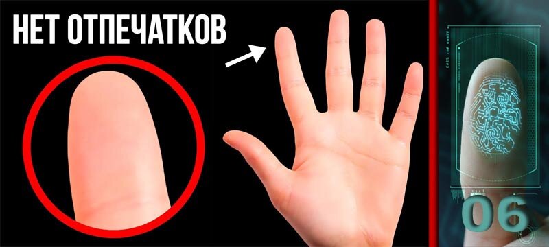 почему исчез отпечаток пальца. адерматоглифия отпечаток. люди без отпечатка пальца. почему исчез отпечаток пальца. болезнь без отпечатков пальцев.