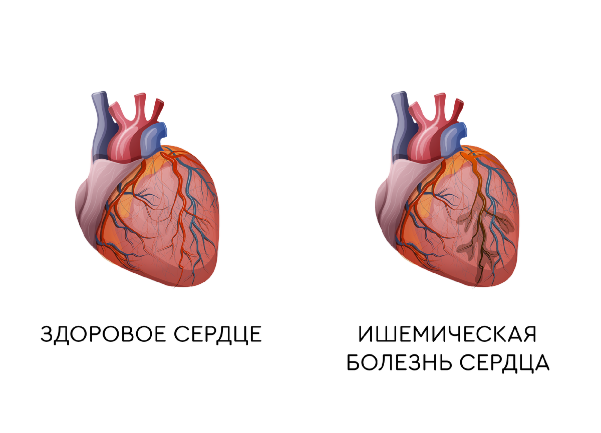 Ишемическая болезнь сердца это инфаркт. Строение сердца при инфаркте миокарда. Инфаркт миокарда ишемическая болезнь. Как выглядит здоровое сердце.
