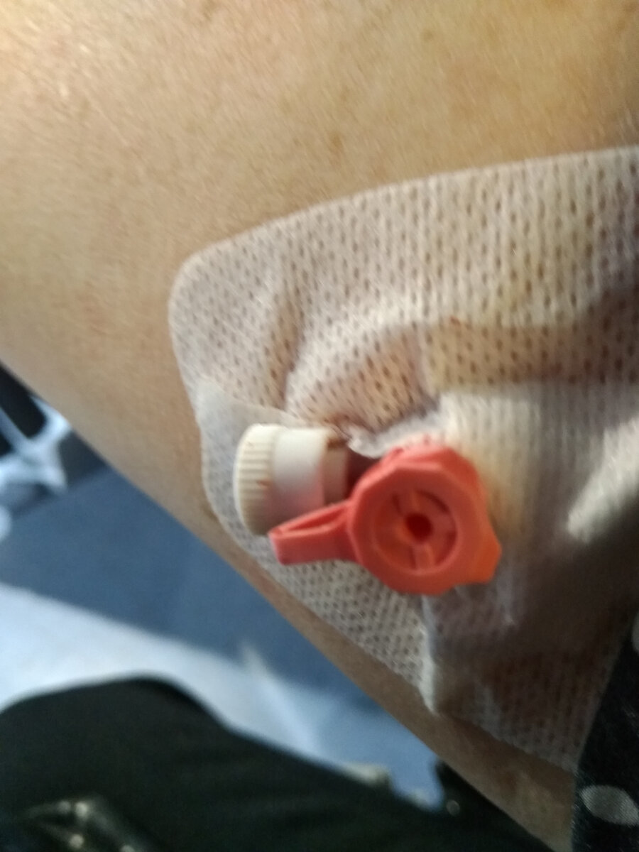 Фото автора. Катетер в вене