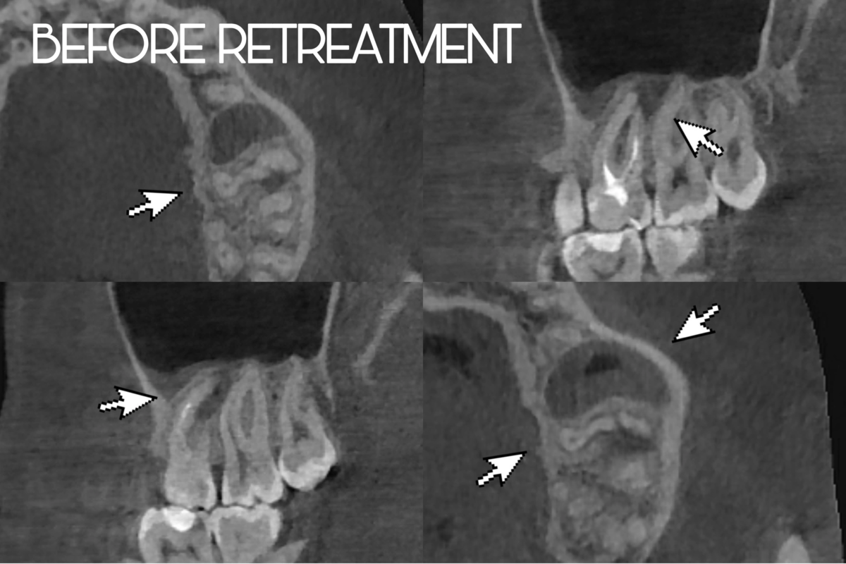 Снимок до лечения, виден патологический процесс на корнях зуба и утолщение слизистой гайморовой пазухи