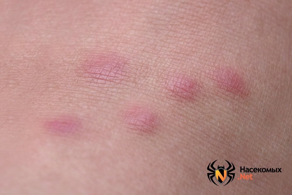 Следы укуса клопов