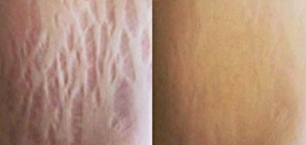 Такого результата можно добиться с помощью лазера. С помощью кремов будет дольше, а эффект не такой поразительный