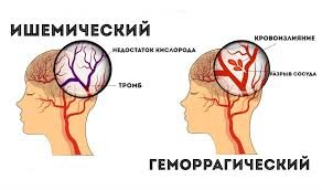 Виды инсульта