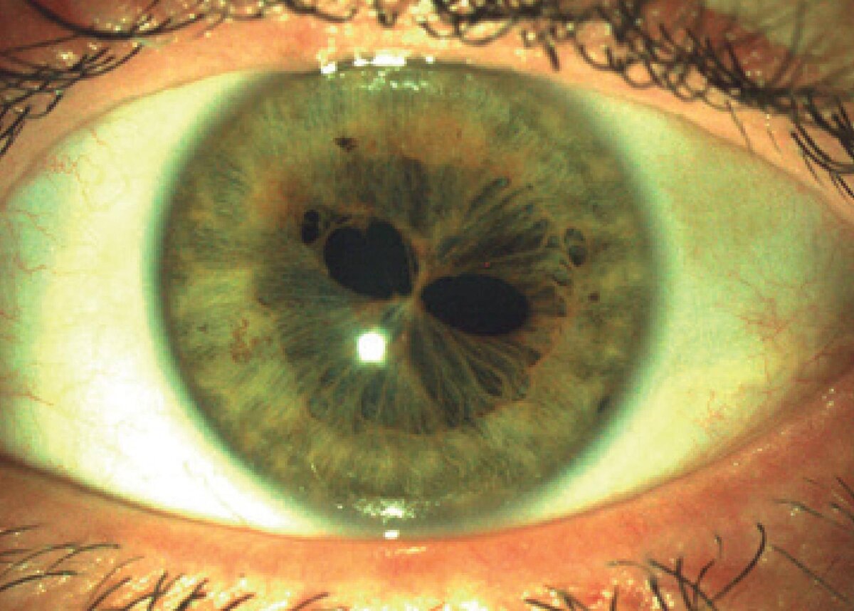 Коронавирус через глаза