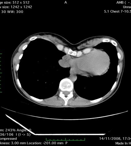 Сдавление сердца и лёгких. Данные КТ. 