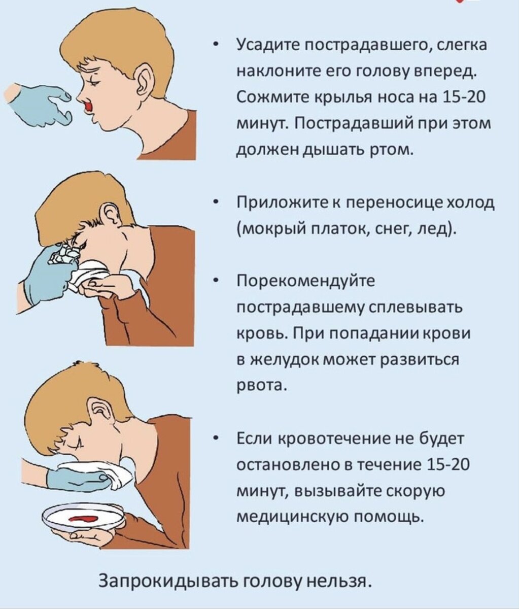 Острое носовое кровотечение. Остановка кровотечения из носа. Первая помощь носовомом кровотечении. Остановка родового кровотечения.