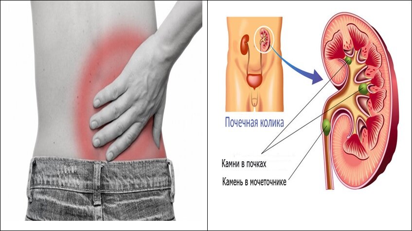 Ноет где почки. Болят почки симптомы.
