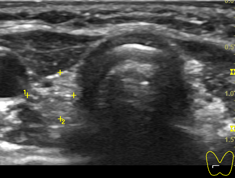 Канадское УЗИ щитовидной железы или 