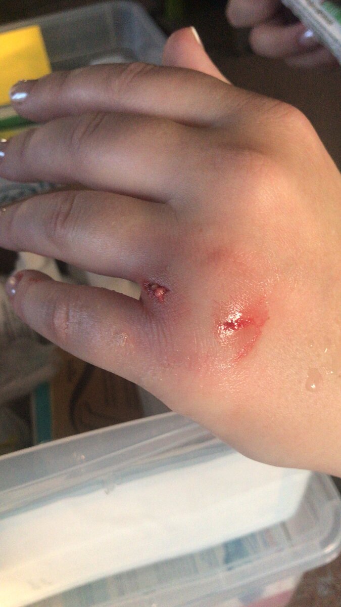 Укус был такой силы, что видно мясо. Фото сделано через час после укуса