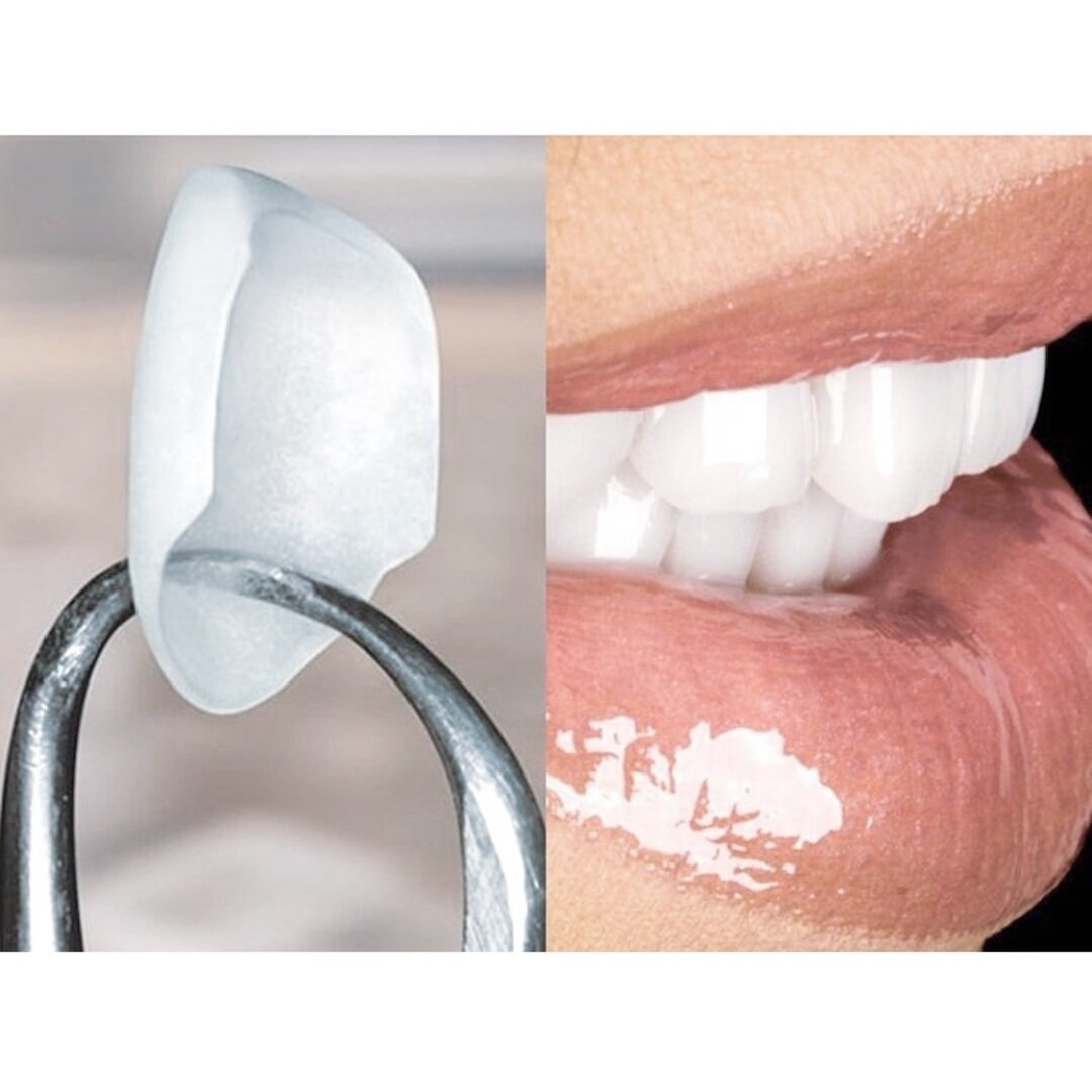 Можно скорректировать цвет, форму зуба, убрать дефекты эмали