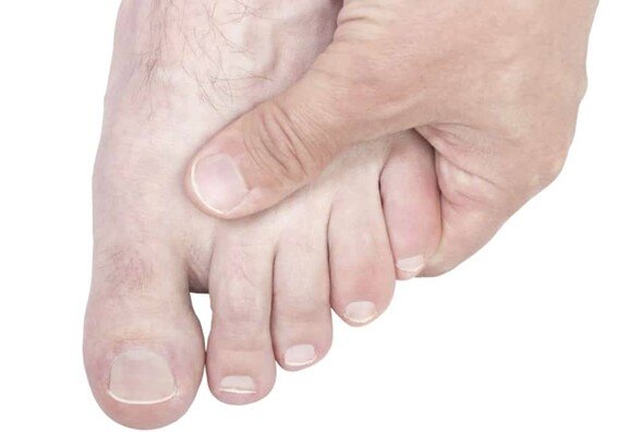 Перелом пальцев на ноге