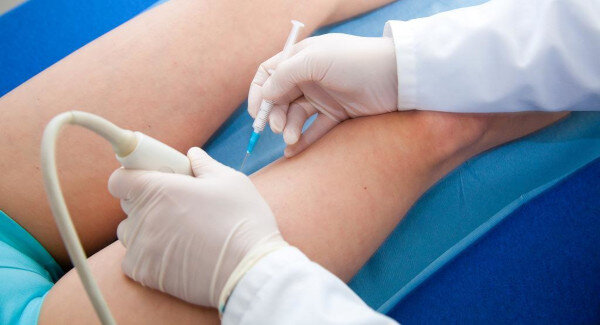 Источник - https://vascul.ru/articles/sclerotherapy-of-veins