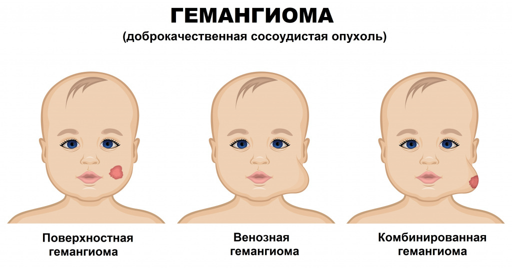 Врожденные опухоли. Младенческая гемангиома.