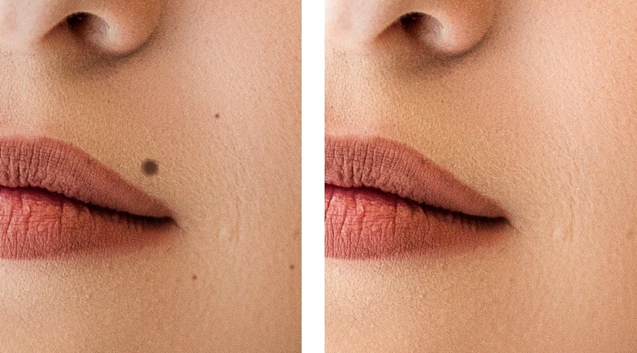 Родинки можно удалить при отсутствии медицинских противопоказаний