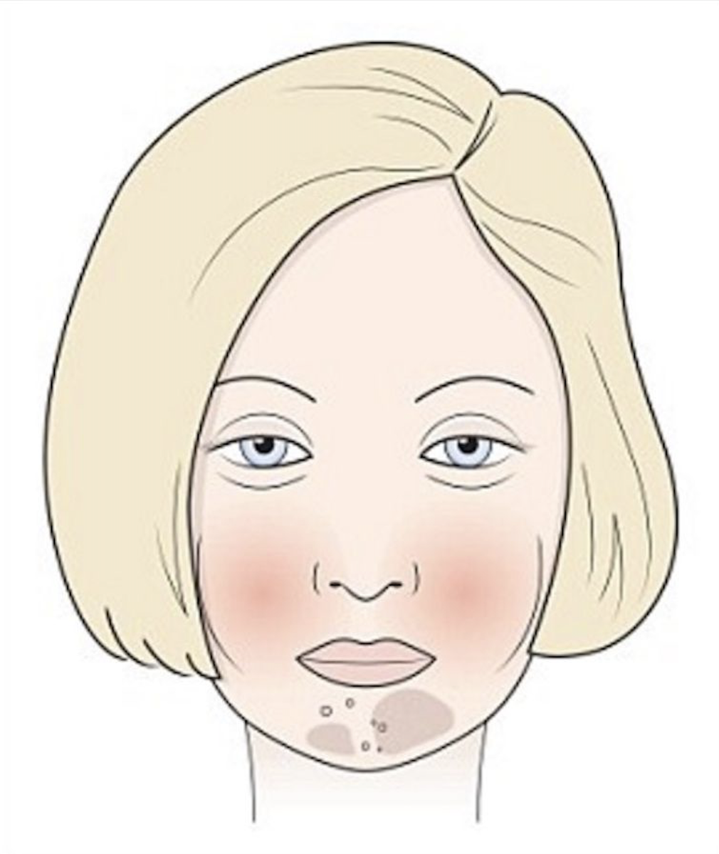 Сахарное лицо. Сахарное лицо признаки. Сахарное лицо признаки. Сахарный тип лица. Сахарное лицо признаки.