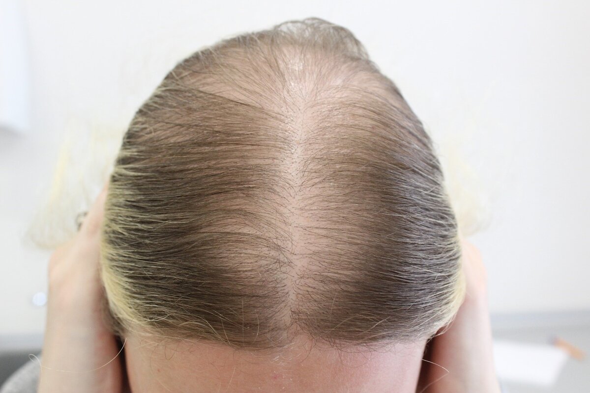 И нет, это не андрогенетическая алопеция.