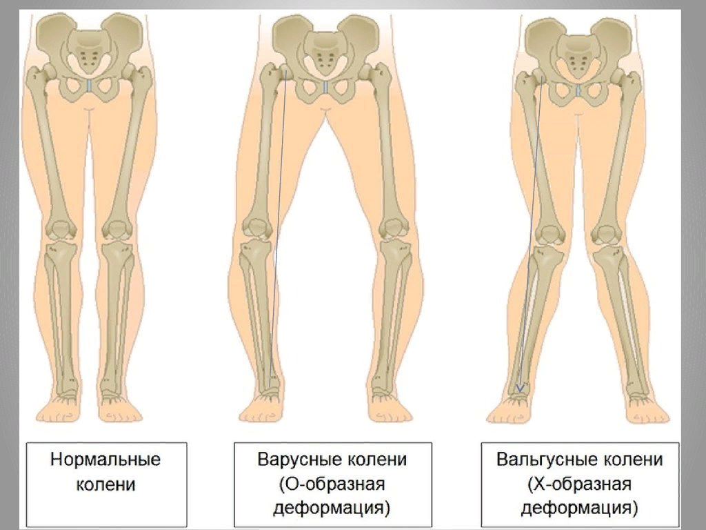 Развитие нижней конечности. Варусная деформация тазобедренного сустава. Варусная деформация коленных суставов степени. Вальгусная варусная деформация сустава. Вальгуснаяеформация коленных суставов.
